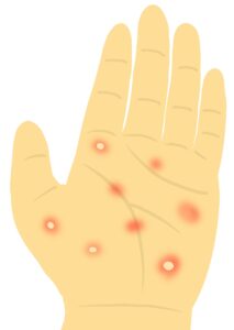 掌蹠膿疱症と漢方のアイキャッチ画像